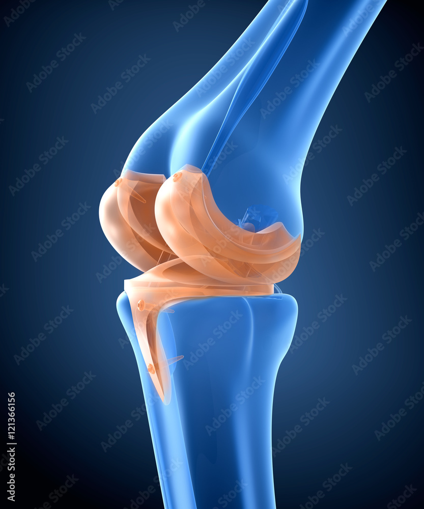 Knee and titanium hinge joint. X-ray view. 3D illustration Stock  Illustration | Adobe Stock