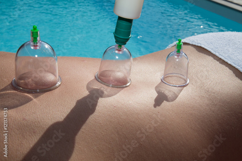 Cupping massage at spa center, a chinese therapy photo