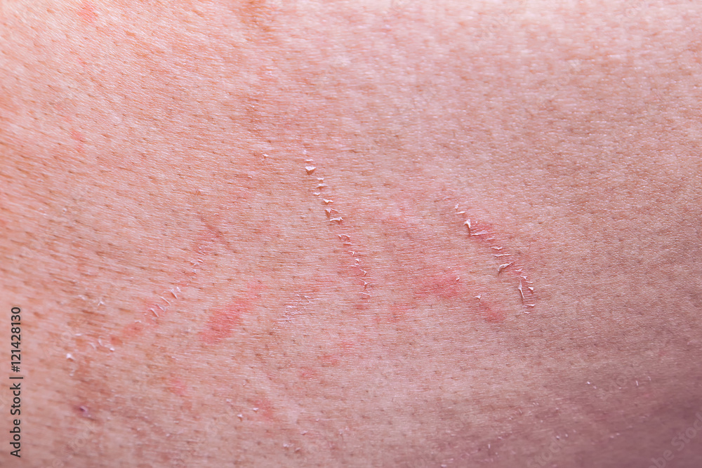 abrasion wound on the skin from scratching.