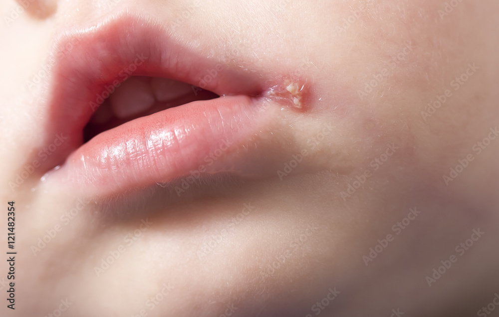 Naklejka premium sore on the lip of the child . herpes