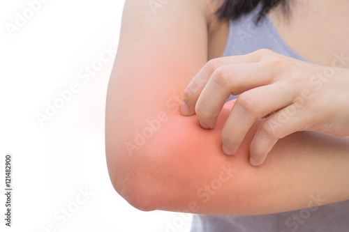 Woman has skin rash itch on elbow