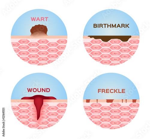 wart , wound , freckle and birthmark skin icon , logo and vector medical