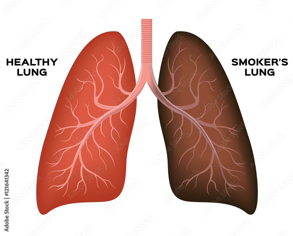 Normal lung , smoker's lung vector Normal lung , smoker's lung vector