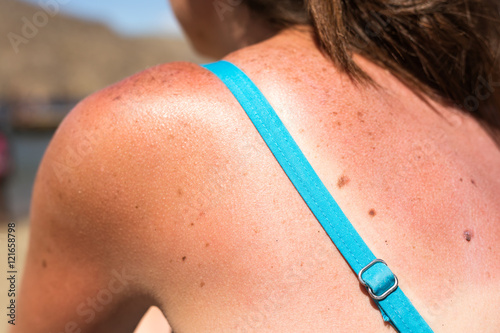 Sunburn from beach sun light on the shoulder and back of caucaci photo