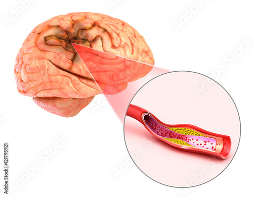 Brain stroke : 3d illustration of the vessels of the brain and causes of stroke photo