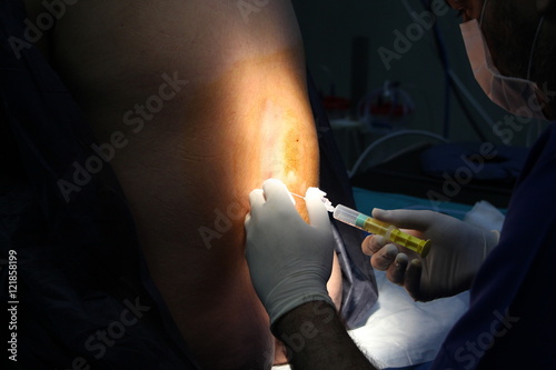 epidural anesthesia