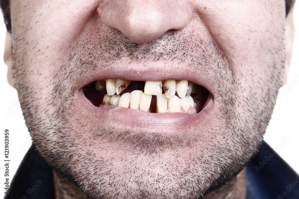 Unhealthy teeth Unhealthy teeth