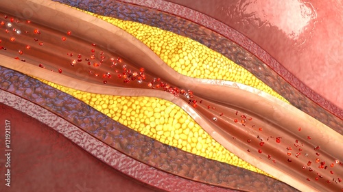 Photos Atherosclerosis