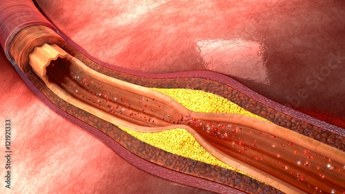 Foto Atherosclerosis