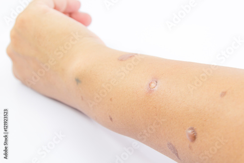 Blisters on skin arm