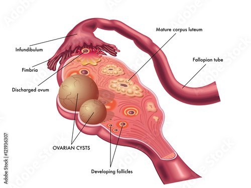 ovarian cyst
