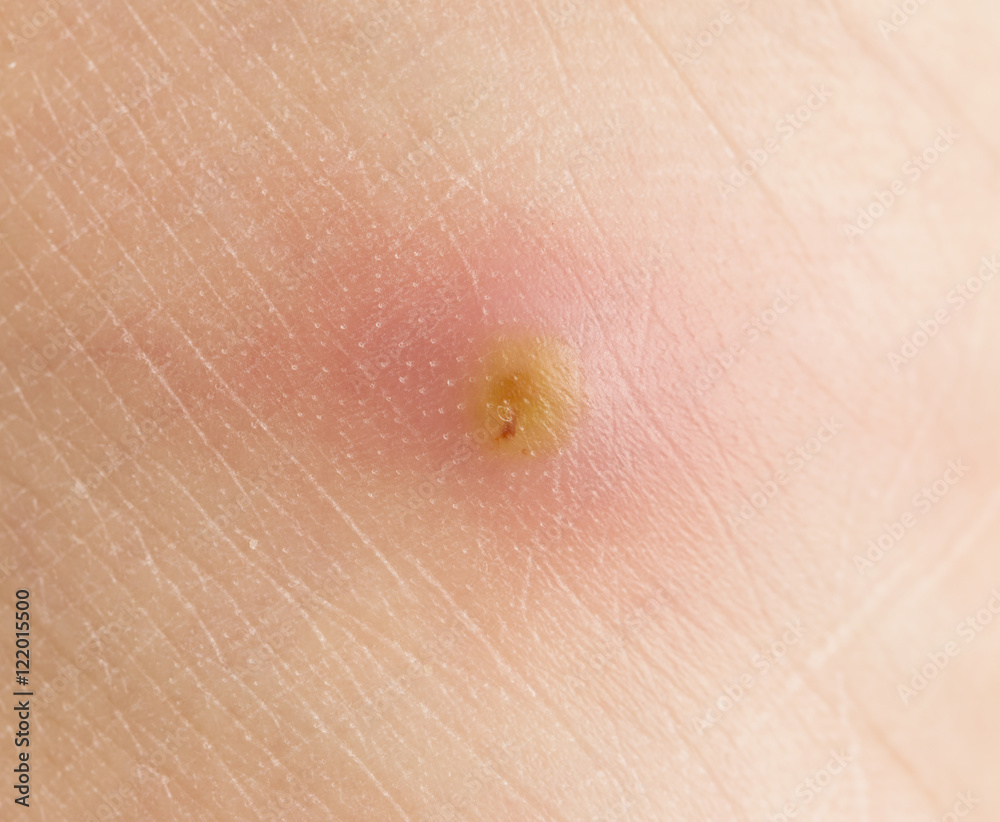 Αυτοκόλλητο abscess with pus on the skin