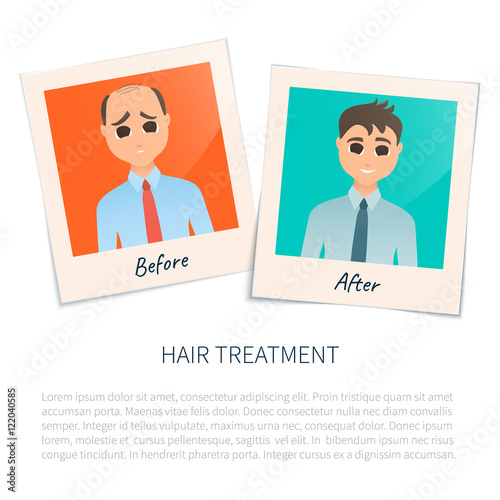 Vector illustration of two photographs of a man before and after hair treatment and hair transplantation. Male hair loss design template. Alopecia medical concept. Vector illustration.
