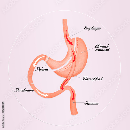 Foto gastric bypass scheme