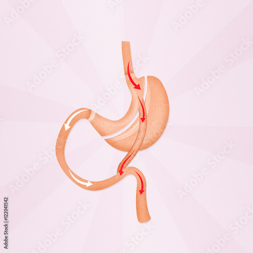 Photos gastric bypass surgery