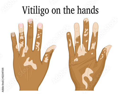 Vitiligo on a palm and on the back of hand