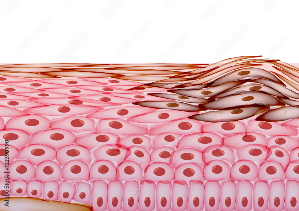 Melanoma in Layers of the Human skin, Cancer - Vector Illustrati Stock ...