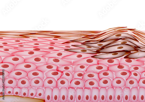 Melanoma in Layers of the Human skin, Cancer - Vector Illustrati