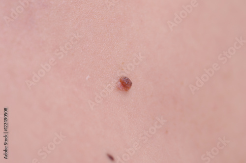 A large mole on a body, close-up.