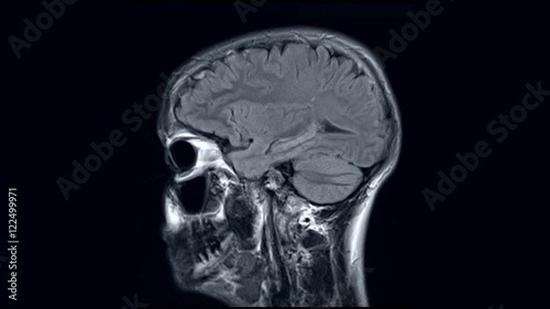 magnetic resonance imaging, MRI MRT head, side view