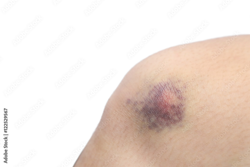 Fototapeta premium close up on a bruise on knee skin