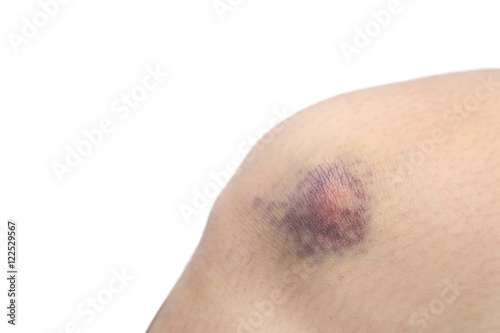 close up on a bruise on knee skin