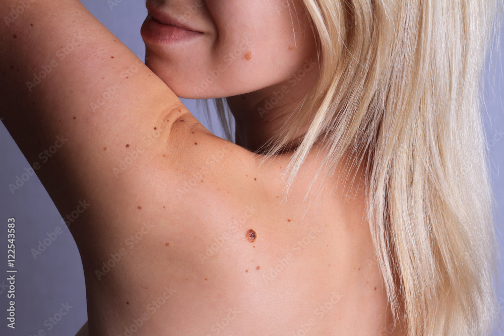 Checking benign moles : Woman with birthmarks on her back and face Checking benign moles : Woman with birthmarks on her back and face