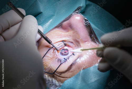 Eye surgery