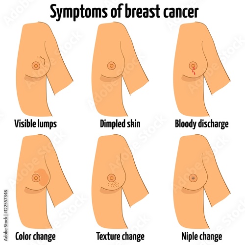 Breast cancer symptoms. Vector illustration. Different symptoms of breast cancer.
