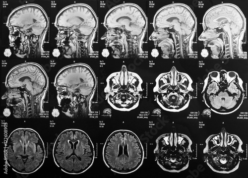 Magnetic resonance imaging photo