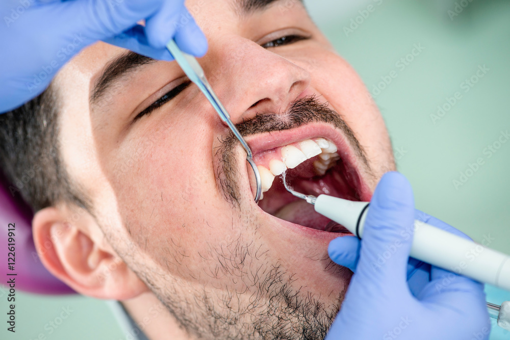 Dental plaque removal Dental plaque removal