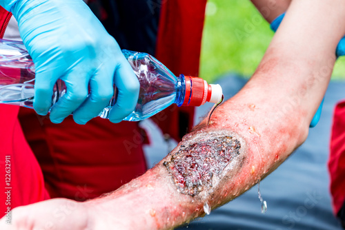 Cooling third degree burn with water. Paramedic training, professional injury make-up