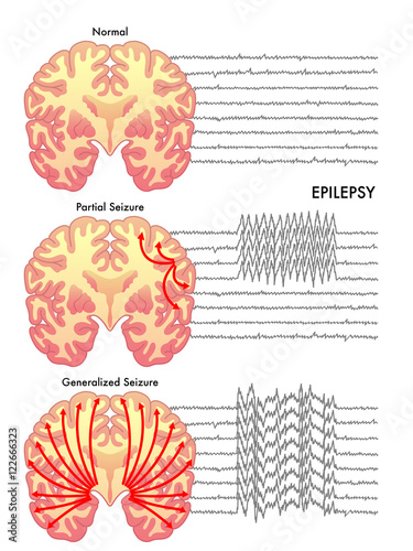 epilepsy photo