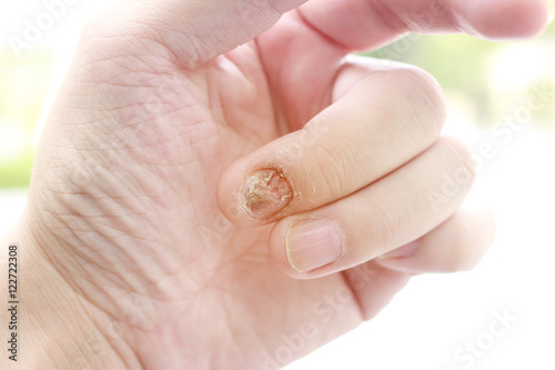 Fungal nail infection and damage on human hand. Finger with onychomycosis