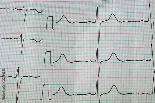 Cardiogram. Cardiogram on special paper for cardiograph.