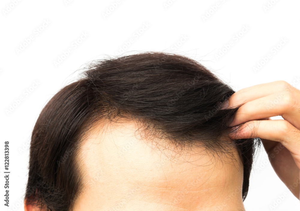 Closeup young man serious hair loss problem for hair loss concept Closeup young man serious hair loss problem for hair loss concept