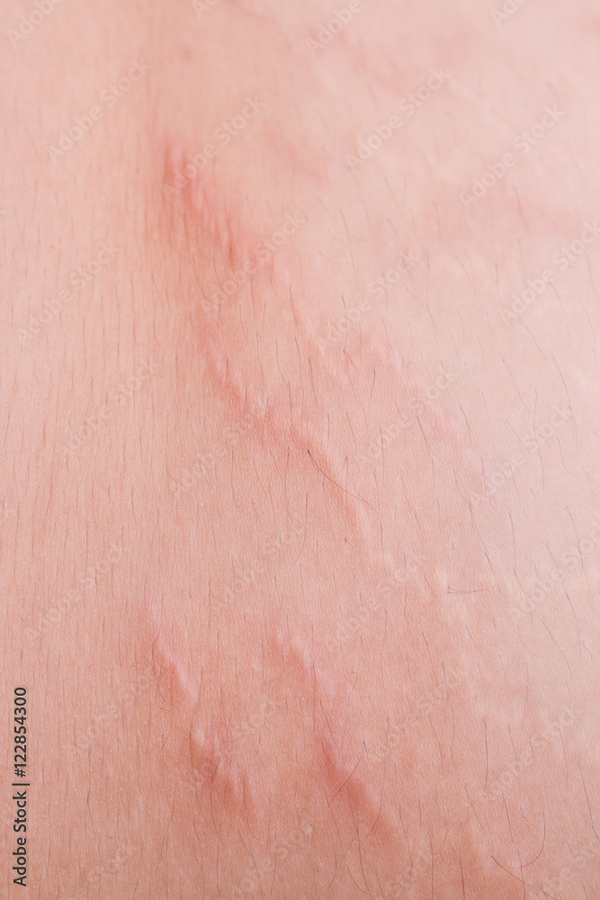 Fototapeta premium Closeup on stretch marks or cellulite on waist belly