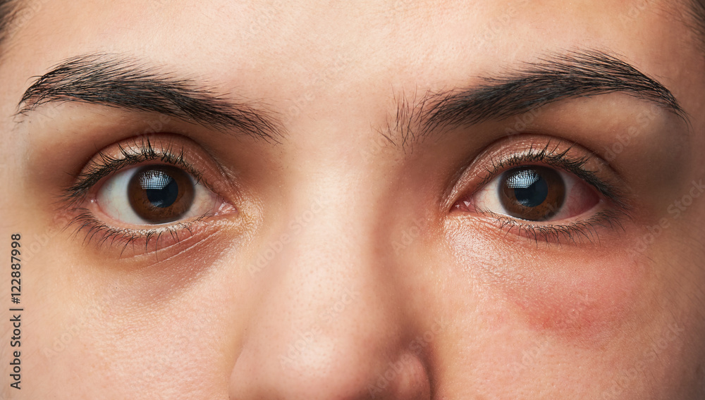 Fototapeta premium allergy reaction on eye