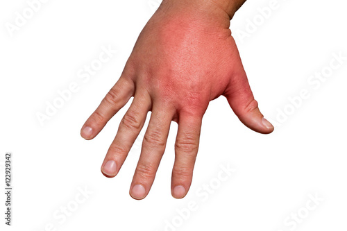 geschwollene Hand nach Insektenstich