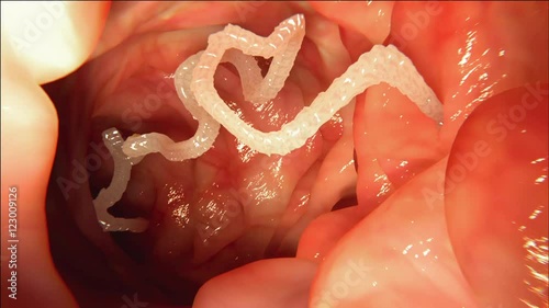 Tapeworm in human intestine photo