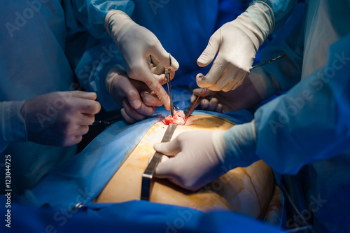 Operation using laparoscopic equipment photo