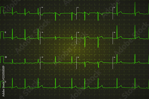 Typical human electrocardiogram, bright green graph on dark background
