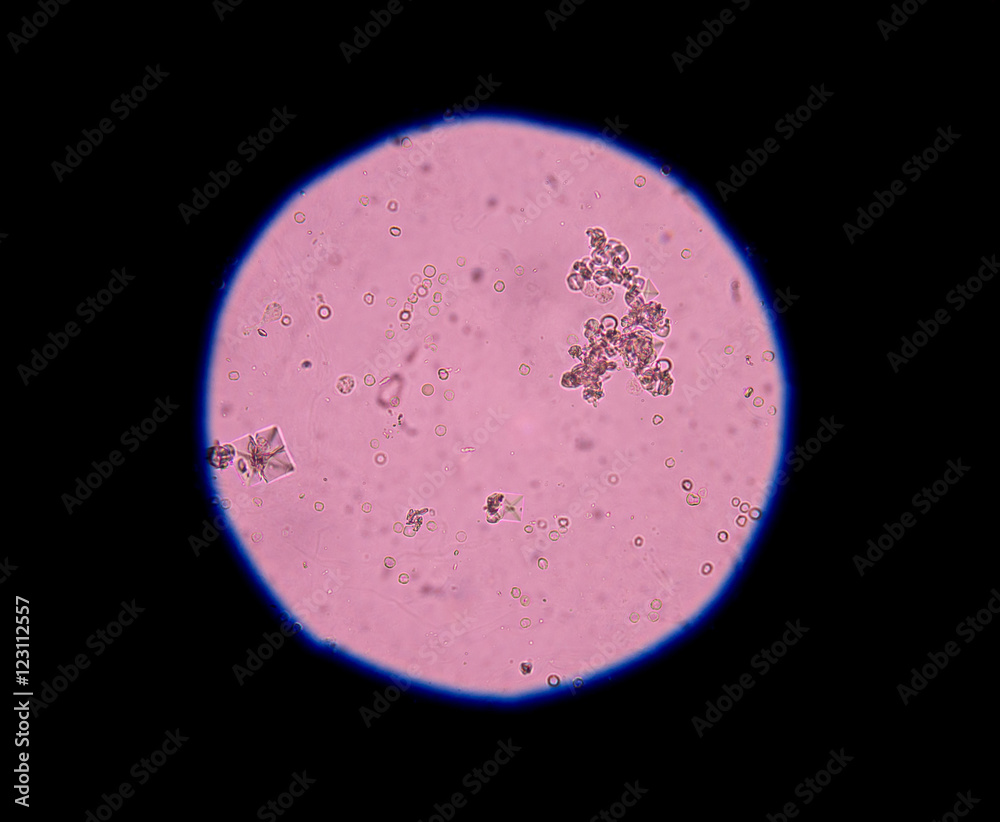 calcium oxalate crystal in urine analysis. Stock Photo Adobe Stock