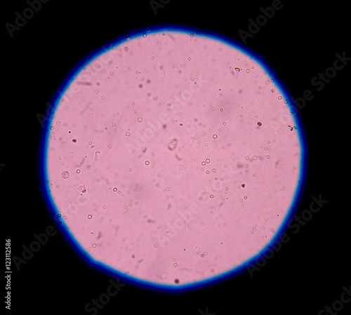 calcium oxalate crystal in urine analysis. photo