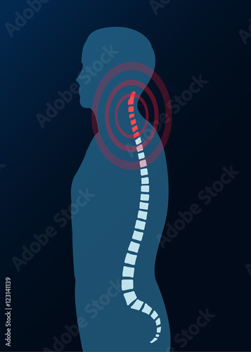 HWS Halswirbelsäule Bandscheibe Röntgenbild mit ausstrahlenden Schmerzen