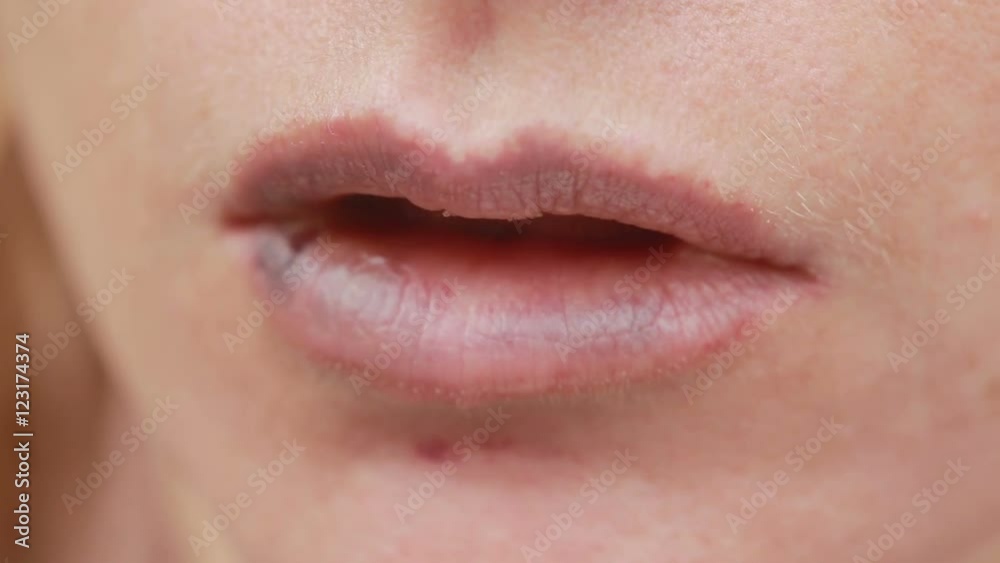 female lips with bruise. closeup. effects of hyaluronic acid. lip