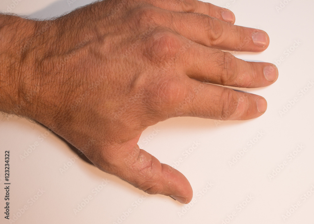 sehr trockene Haut Neurodermitis sehr trockene Haut Neurodermitis