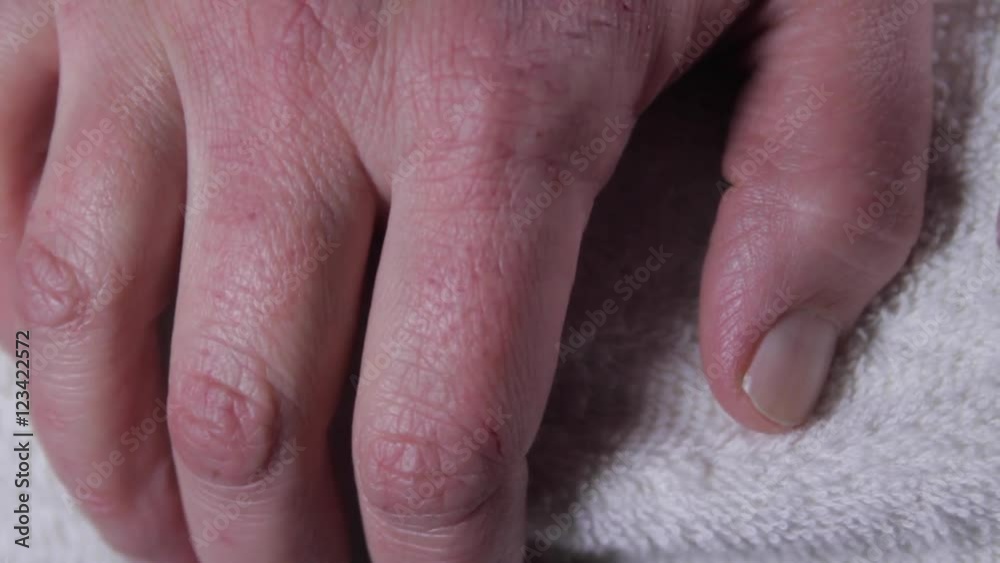 Woman Hand With Severe Allergies To Cold, Frost Bite, Itchy Skin, Close Up, Tilt Woman Hand With Severe Allergies To Cold, Frost Bite, Itchy Skin, Close Up, Tilt