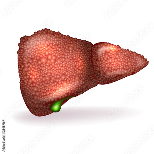 Cirrhosis of the Liver anatomy illustration