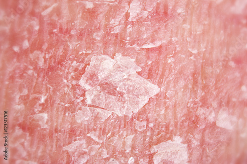 Psoriasis, psoriatic skin disease is red, itchy, and scaly, macro with narrow focus